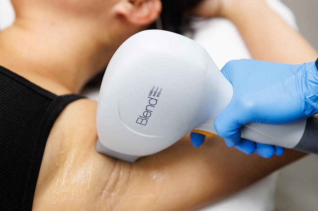 Laser hair removal treatments